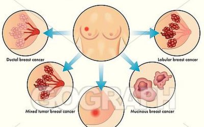 What are the 4 types of breast cancer?